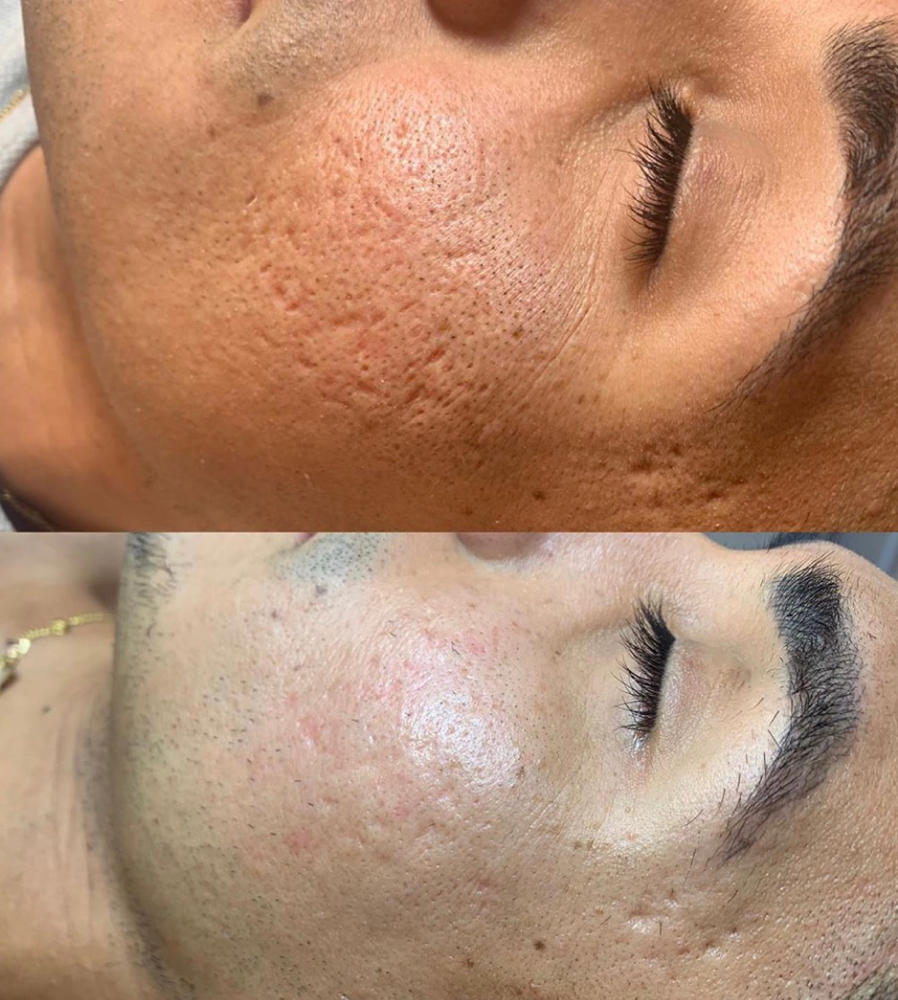 Microneedling