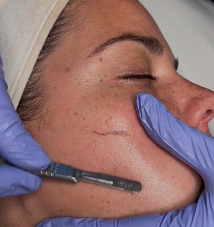 Dermaplaning Treatment With Facial