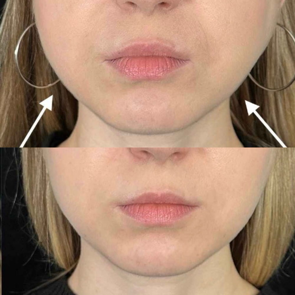 Tox-DAXXIFY Masseter