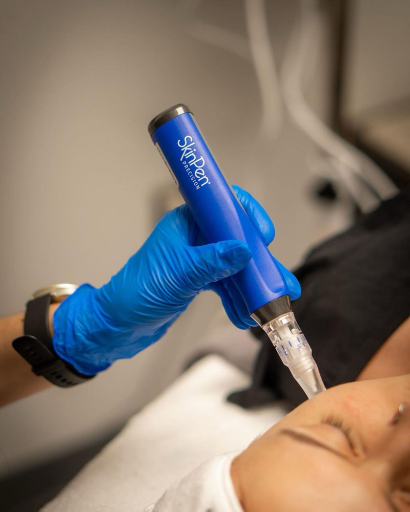 SkinPen Microneedling