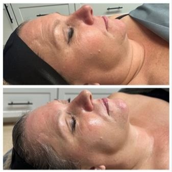 Krista Signature Glowgetter Facial at Marco Island Aesthetics