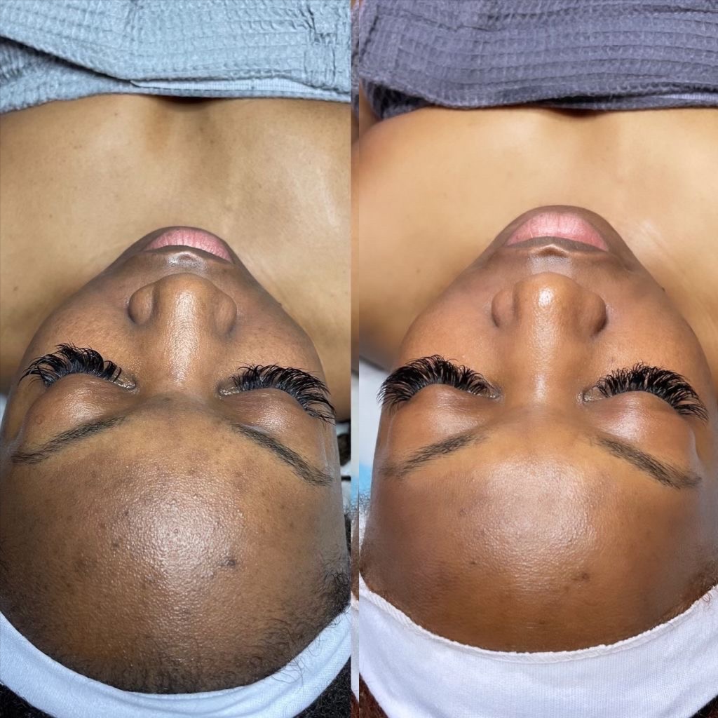 Advanced Chemical Peel Ritual at Xo Nail Salon in Watseka, IL