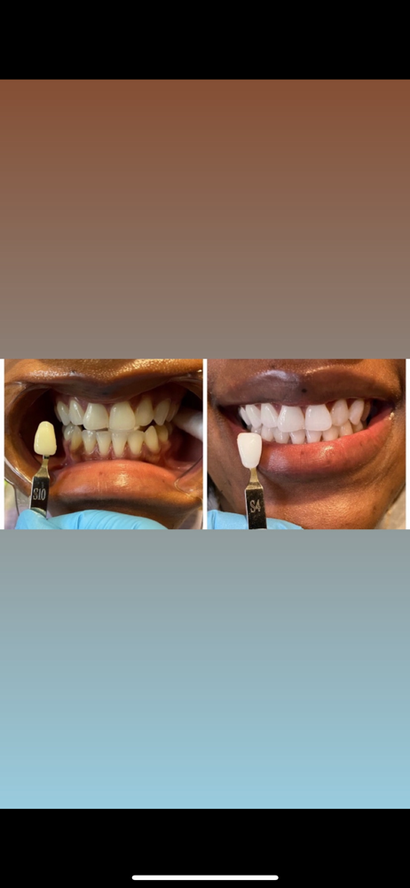 60 Minute Whitening Session