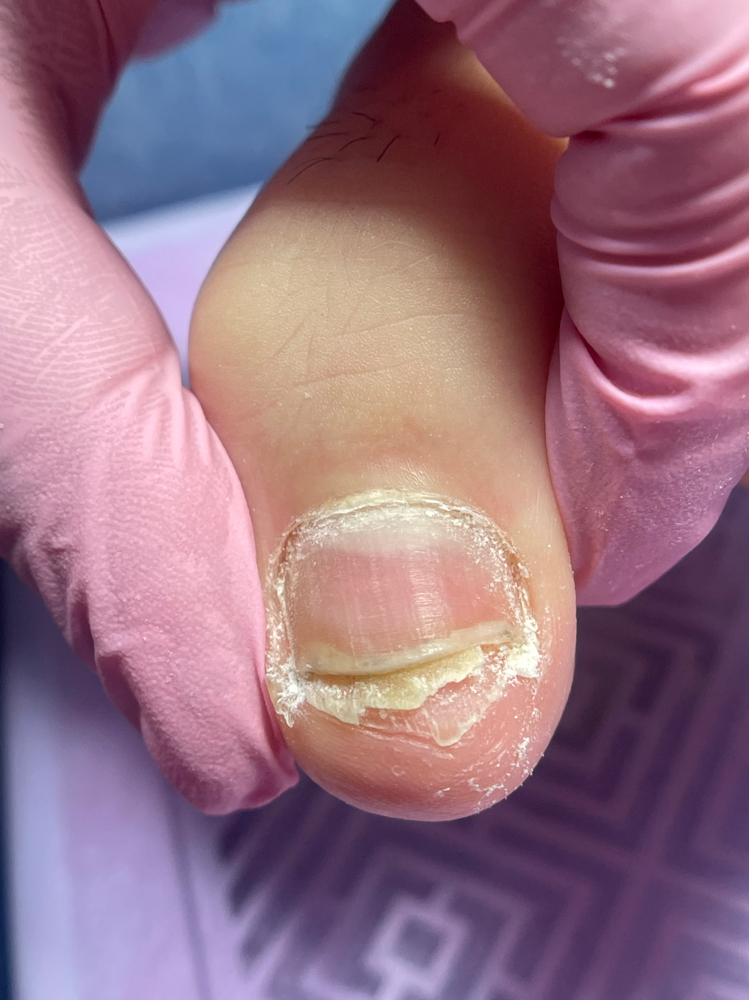 Primer Tratamiento Ibx Restaura Uña