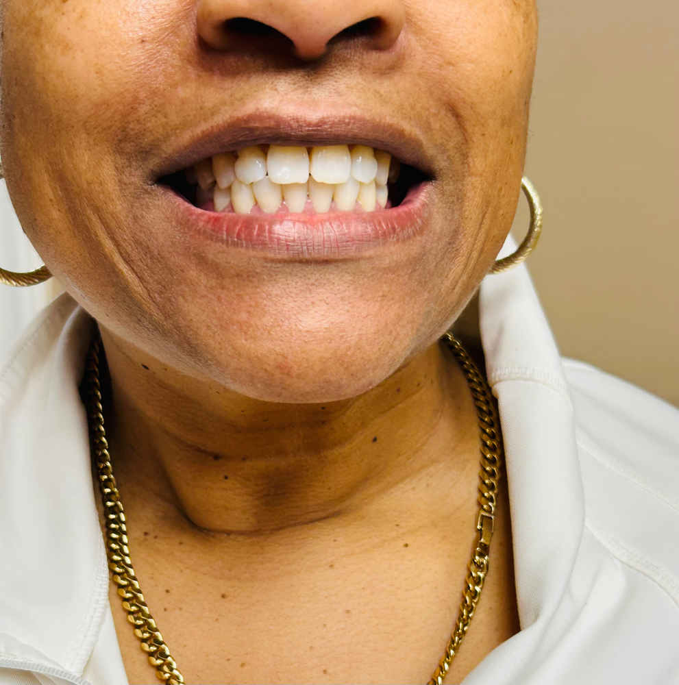 Teeth Whitening