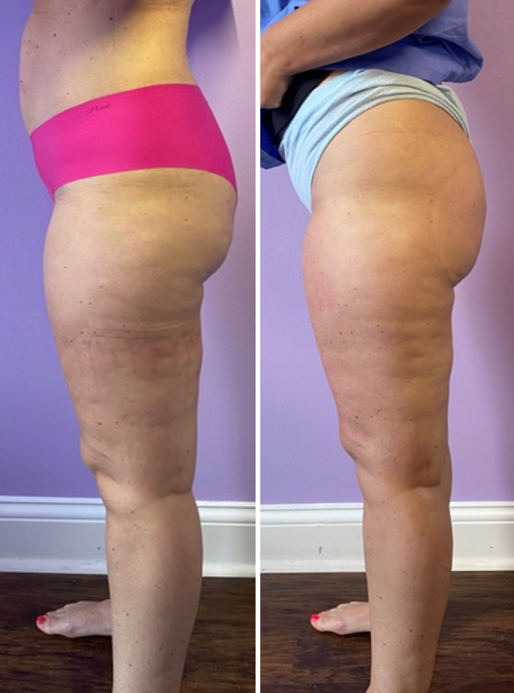 Booty Lift Sculpting