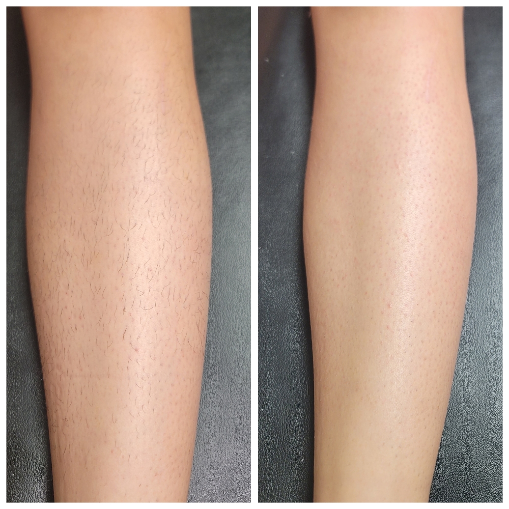Lower Leg