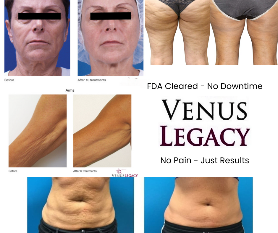 Venus Legacy Lift & Contour