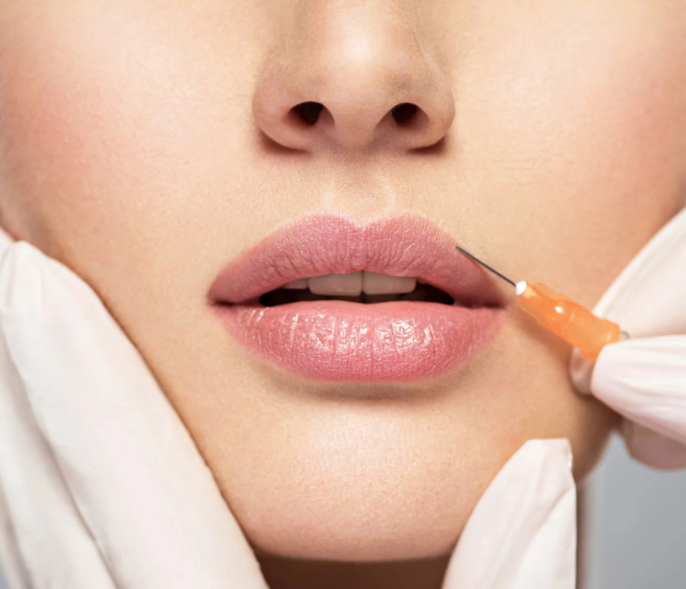 Lip Filler