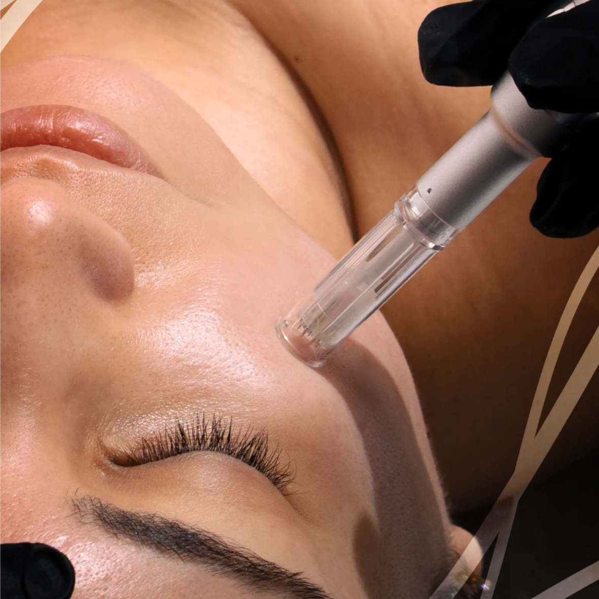 Microneedling at Salon Ambiance in Fall River, MA