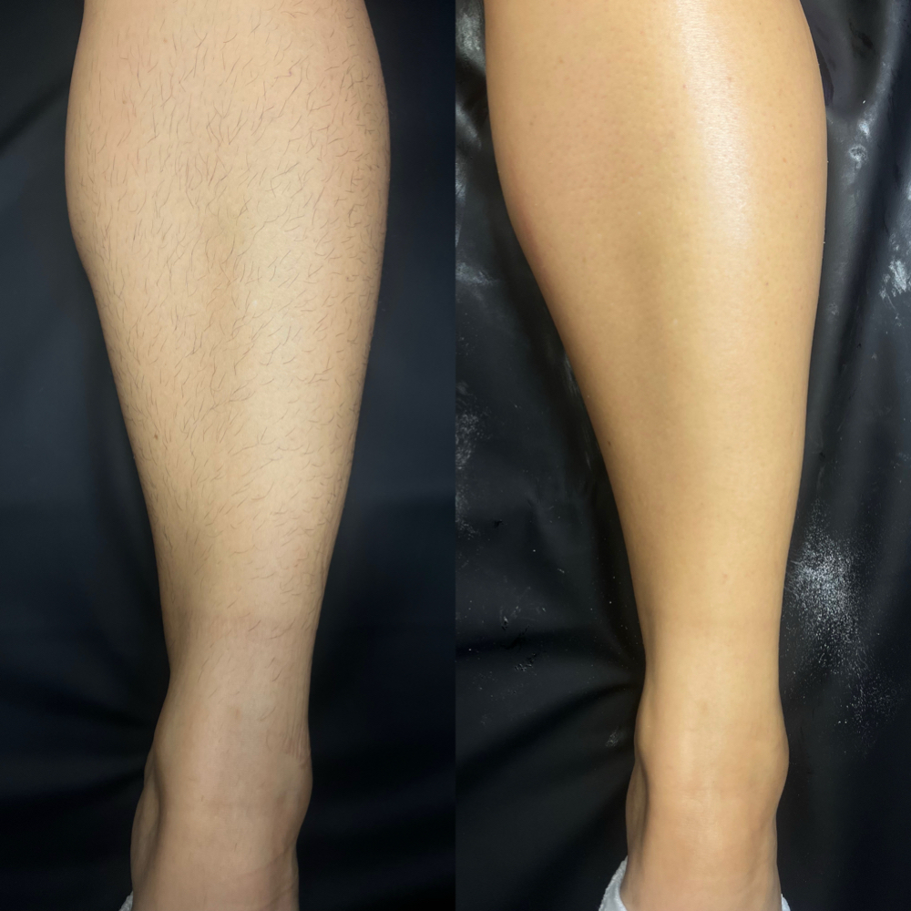 Leg Wax at LoveThyself Aesthetic in Oklahoma City, OK