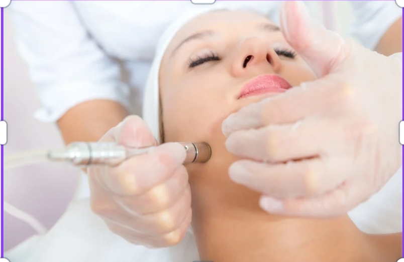 Microdermabrasion