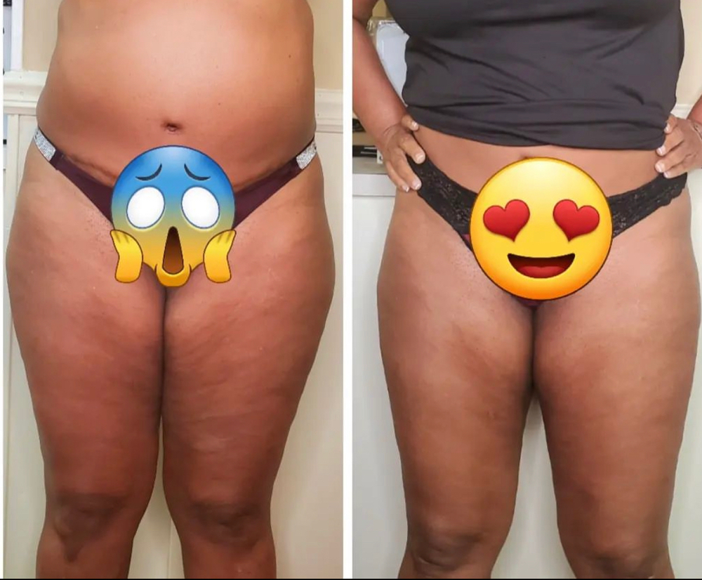 Body Cavitation/ Wood Therapy Combo