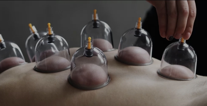 30-Minute Cupping Treatment
