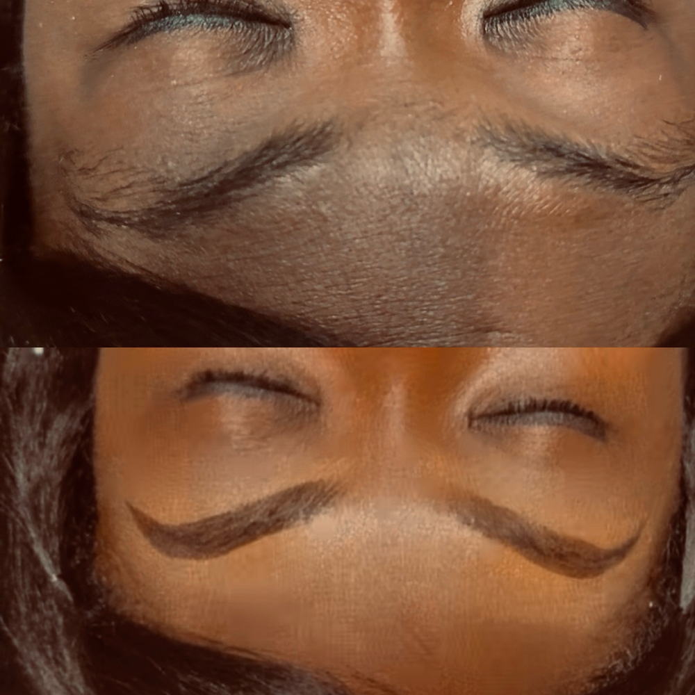 Conceal and Fill at MarlyMar Aesthetics in Alexandria, LA