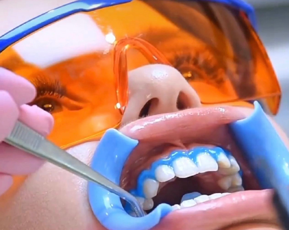 Teeth Whitening 3 Sessions