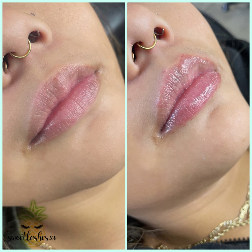 Needless Lip Filler Retouch 2ml