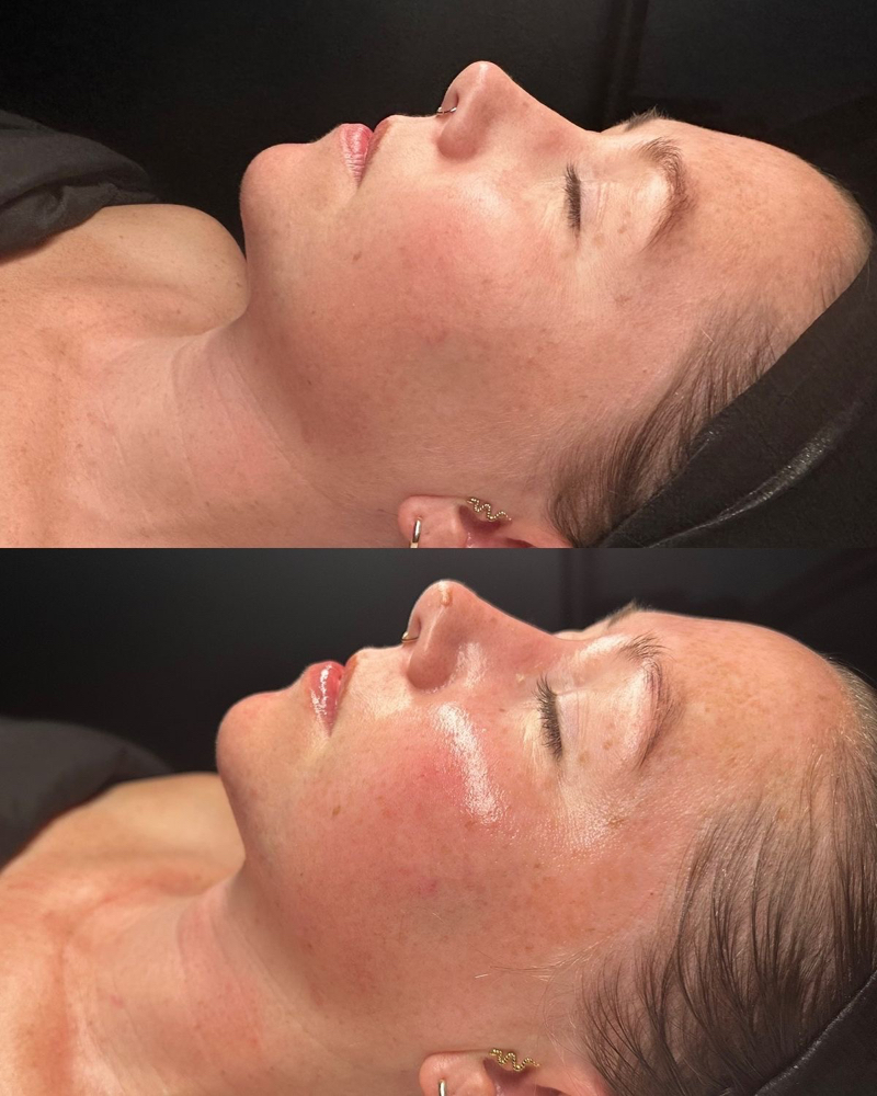 Microdermabrasion + Dermaplaning