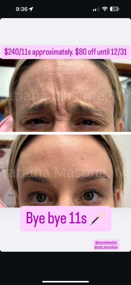 Concierge Botox/Jeuveau