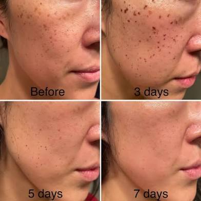 IPL Laser Treatment Consultation
