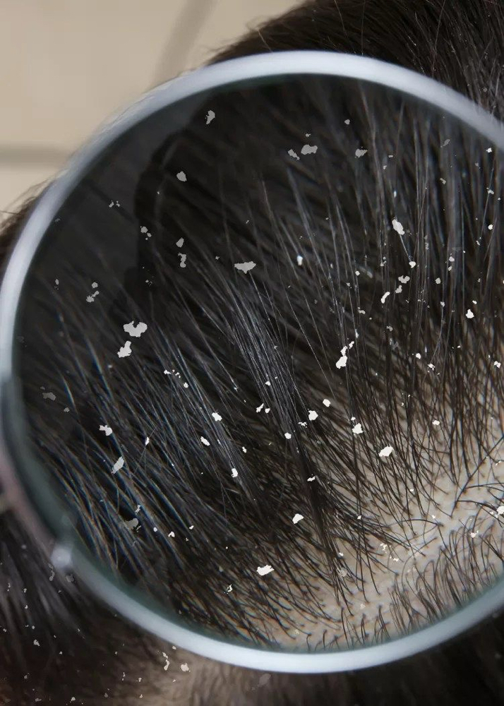 Dandruff Removal For Thick Hair