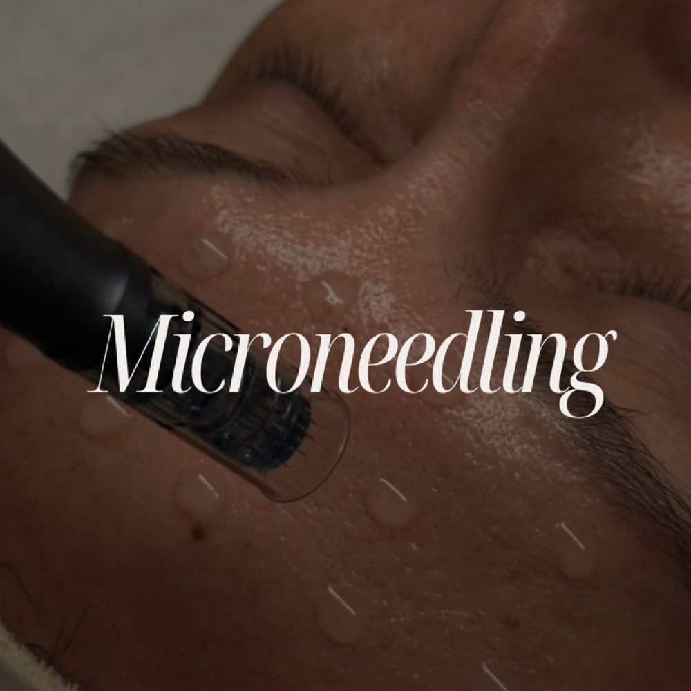 Microneedling at Madsesthetics LLC in Litchfield Park, AZ
