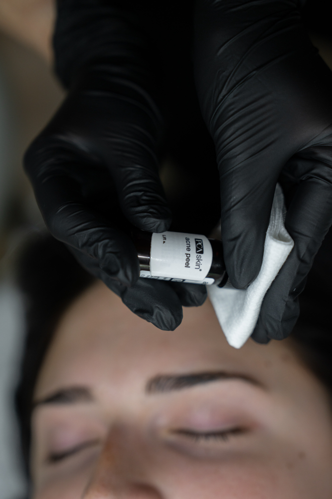 Face Peel Add On