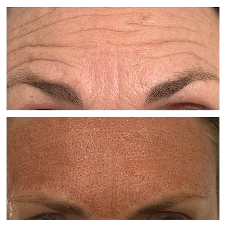 forehead Wrinkle Reduction