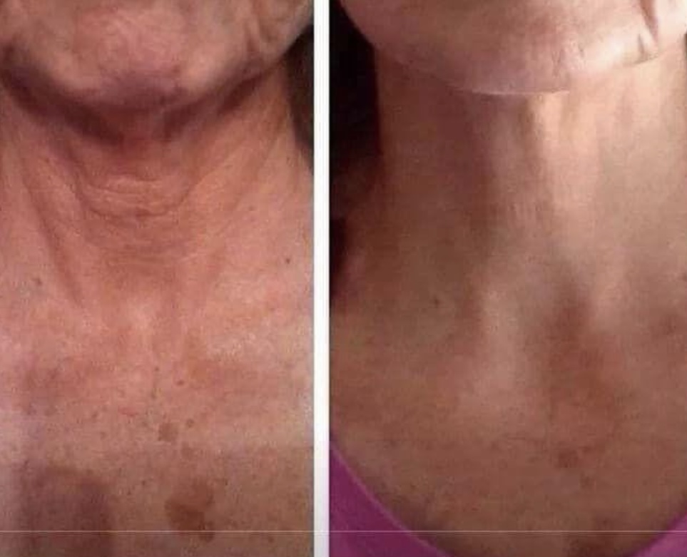 MicroChanneling Neck