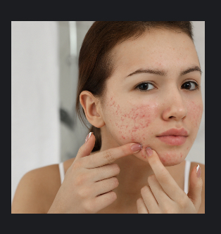 Prepaid Acne Bootcamp (6 Treatments