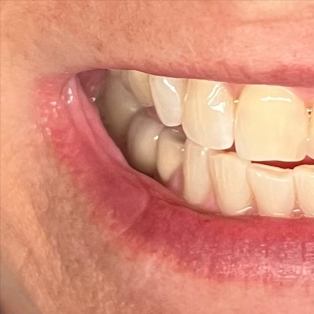 Teeth Whitening 45 minutes at Beauty By Stevie D in Livingston, TX