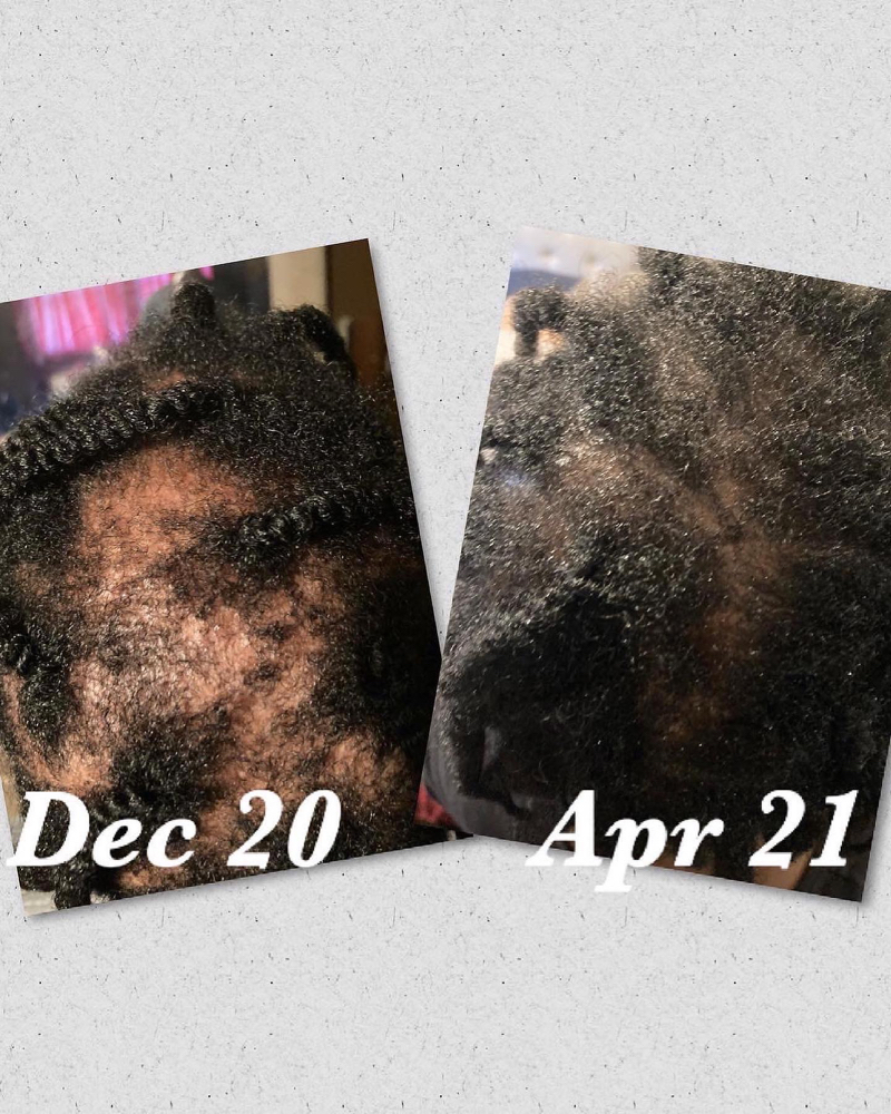 Full Hair Loss Workup