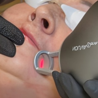 NOUVADerm RESURFACING PKG OF 3 at WilKay Wellness & Aesthetics in Gilbert, AZ