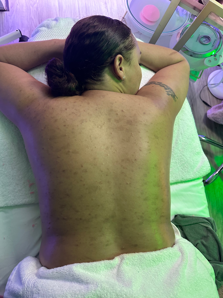 Summer Back facial
