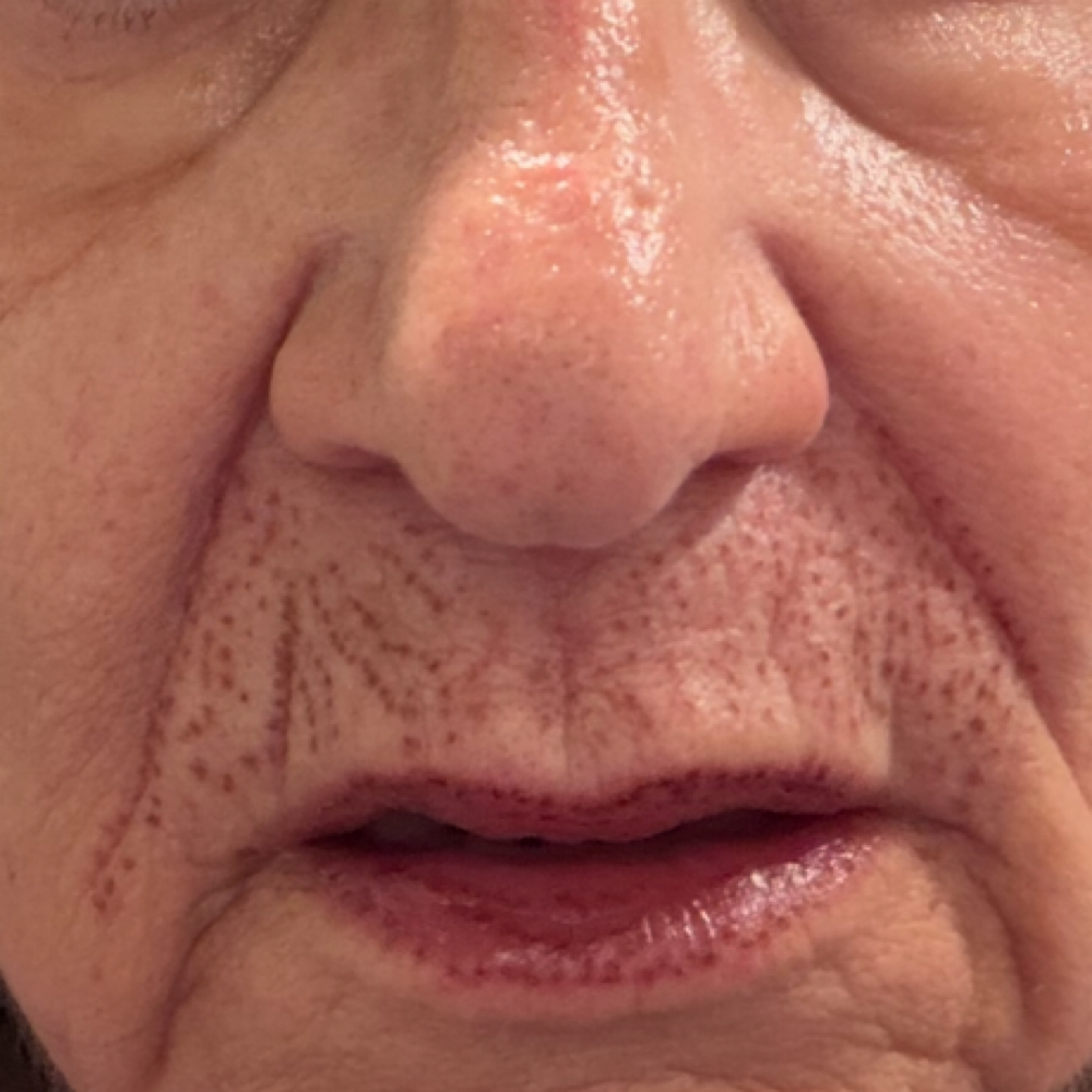 Upper Lip Lift at Excellent Nails By Sandy in California, CA