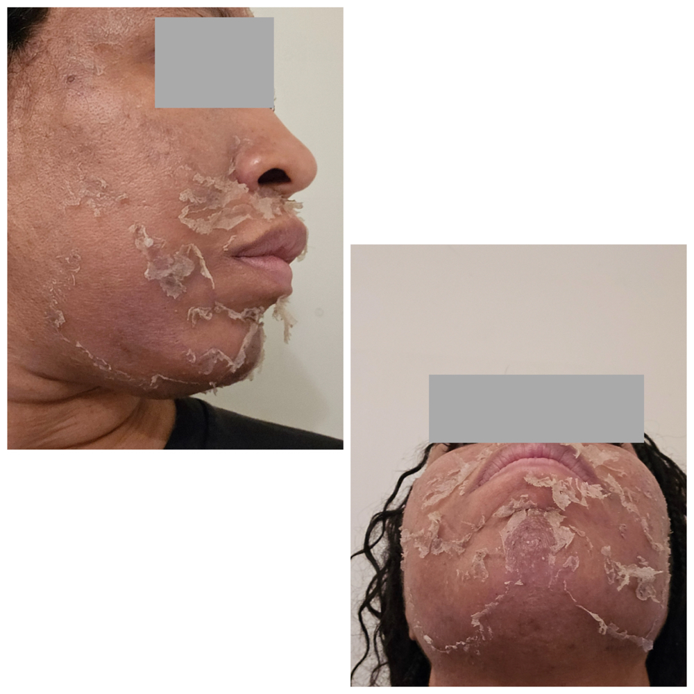 Chemical Peel Level 2