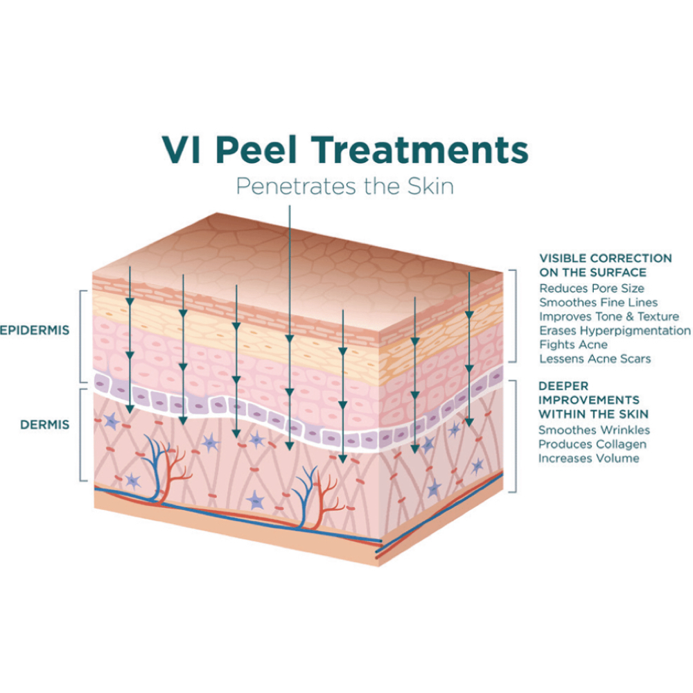 VI Peel at ALL HEART BEAUTY: Esthetics & Wellness in Advance, NC