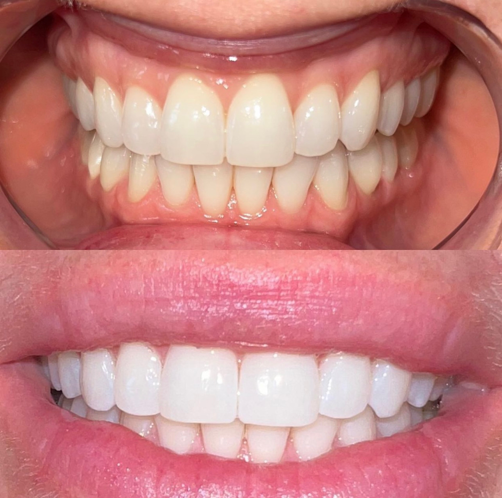 Teeth Whitening Package (3)🦷