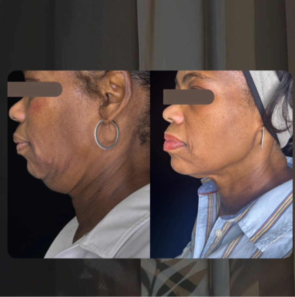 Double chin reduction at Corrective treatments + professional skincare in Atlanta, GA