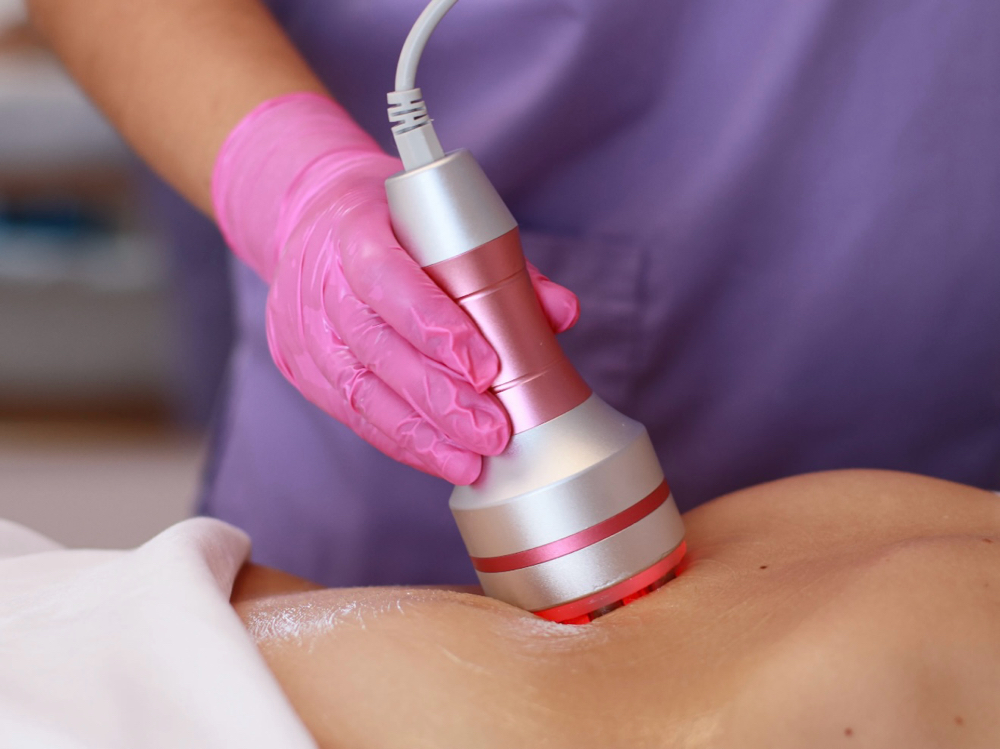1 Zone Cavitation+Rf-lifting (stom)
