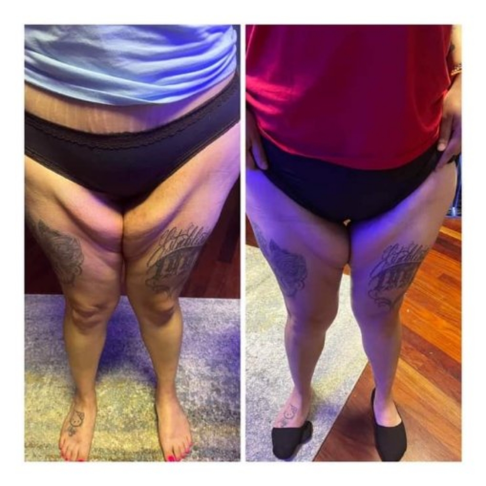 ⭐ Inner Thigh Reduction Treatment at JUST BEAUTIFUL SKIN in Goose Creek, SC