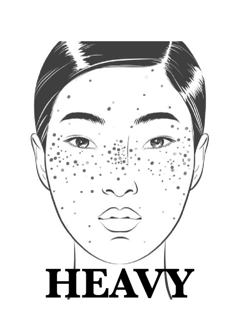 Freckles -Heavy coverage