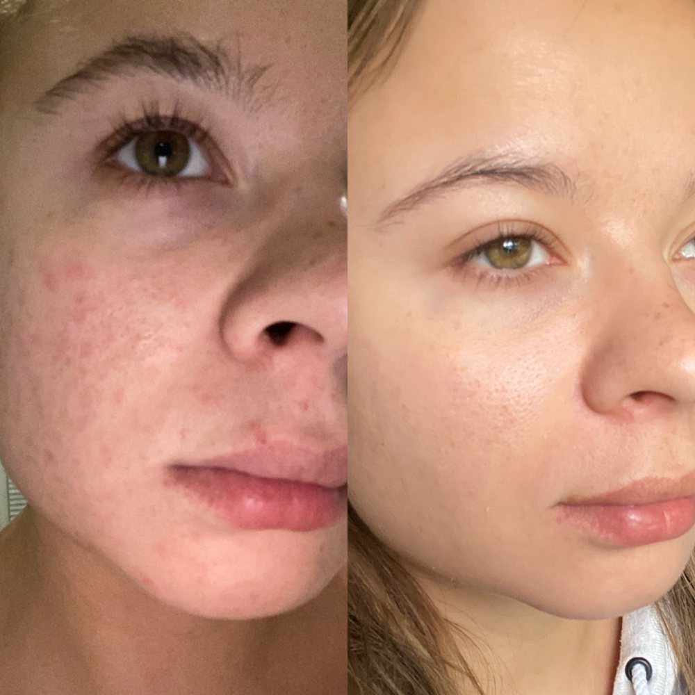 RETURNING Acne Clearing Facial