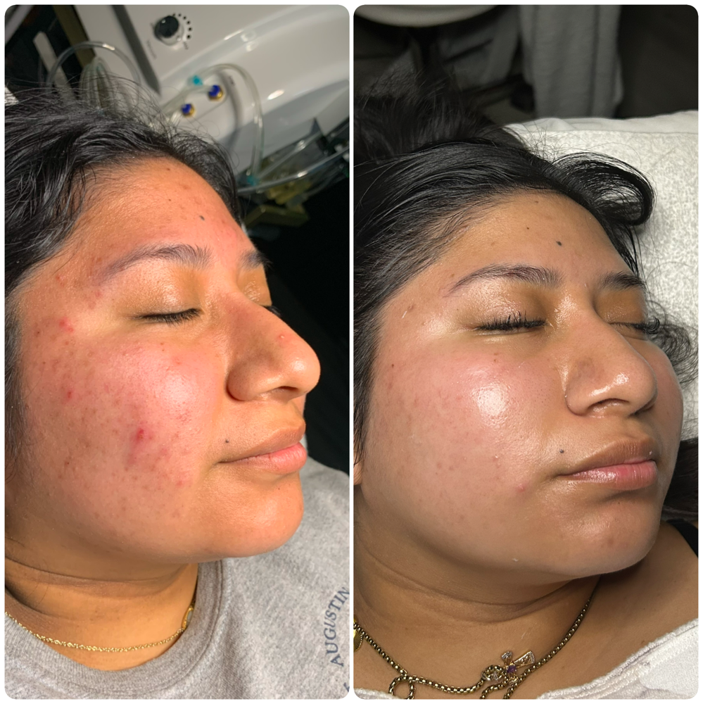 Acne boot camp consultation
