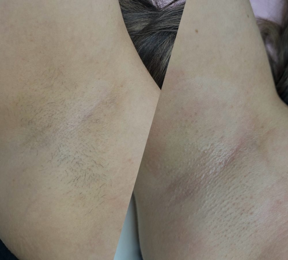 Underarm Waxing