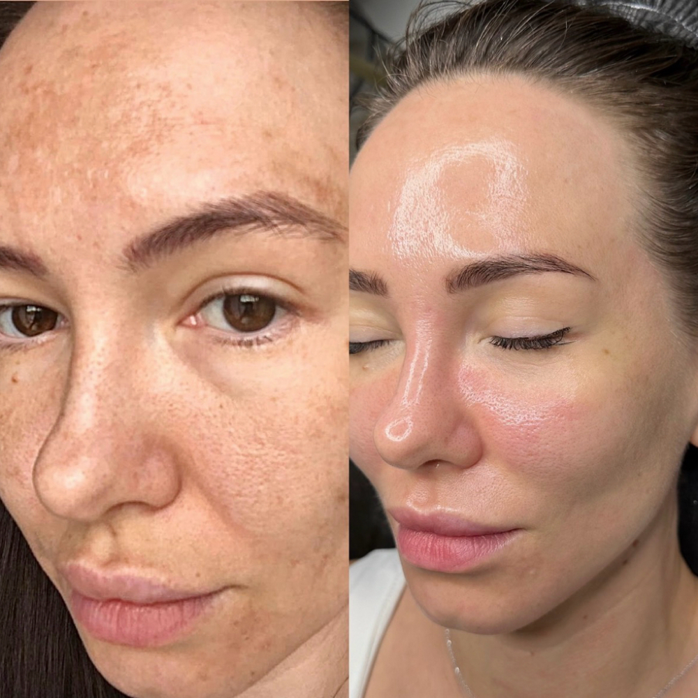 Pink Glow Treatment at Āvra Beauty Spa in Irving, TX