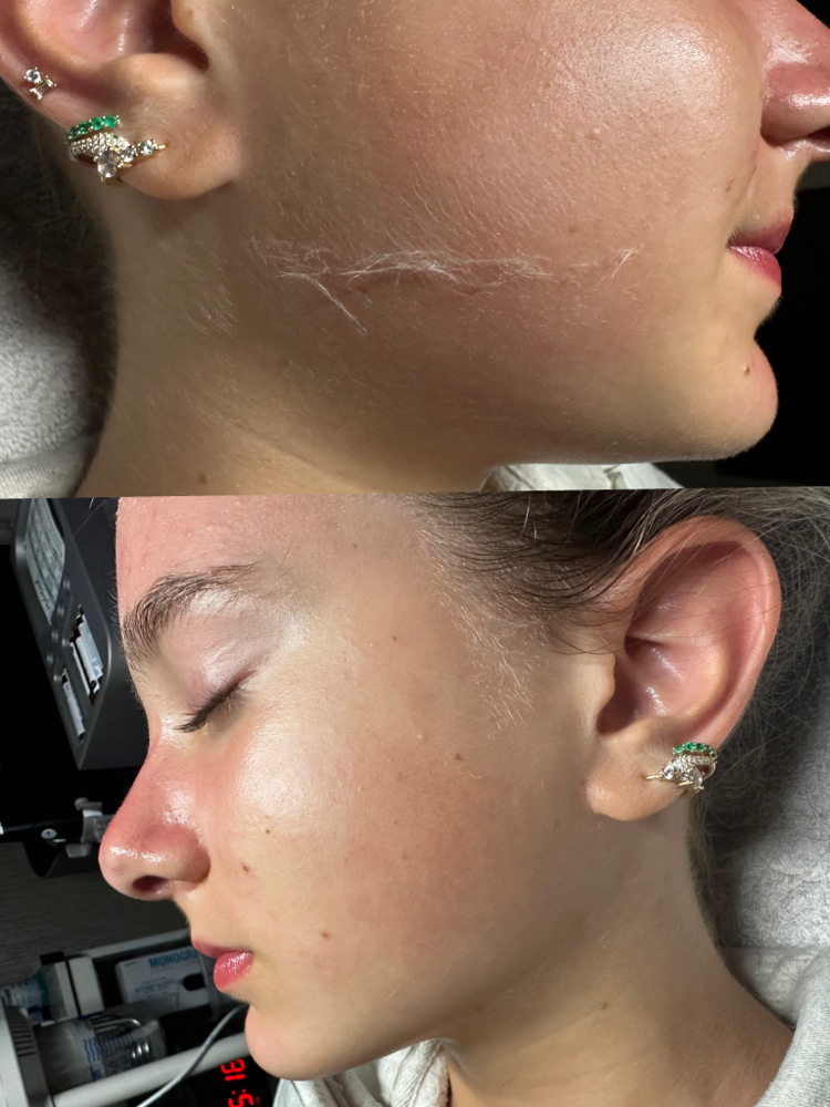 Dermaplaning Facial