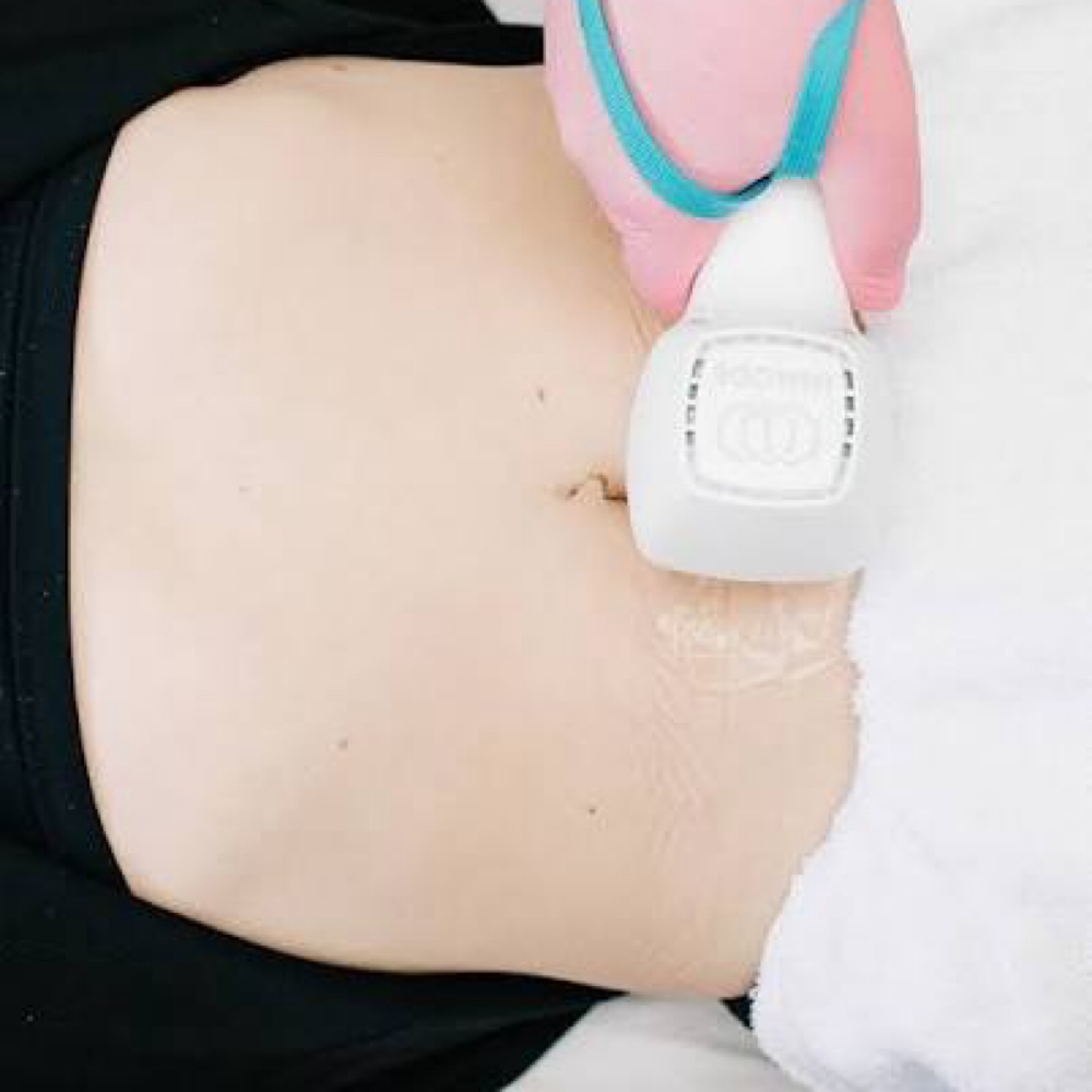 Laser Hair Removal Full Stomach at All Aesthetics Kare in Upland, CA