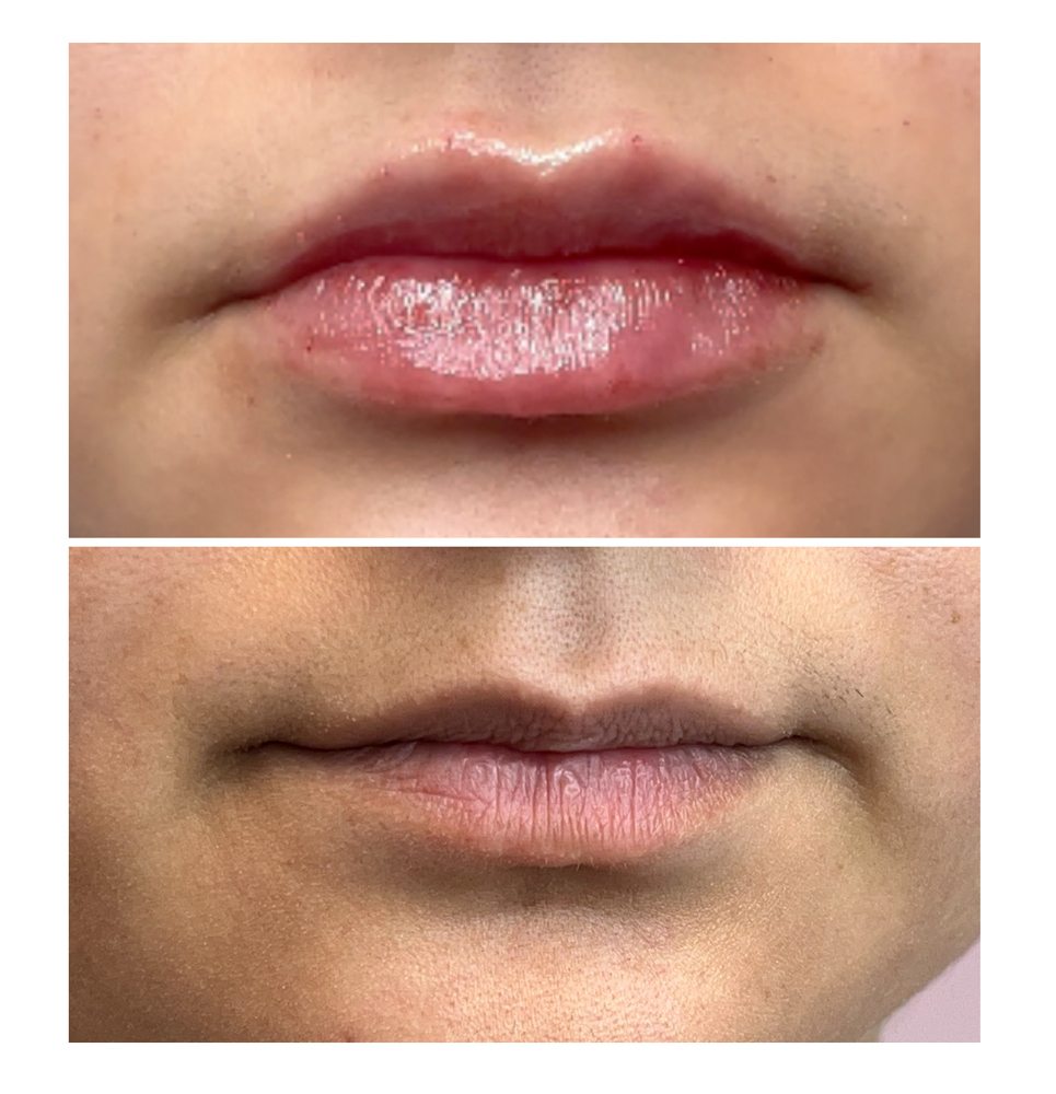 Lip Filler 1/2 Syringe