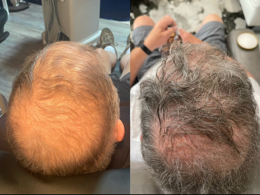Microneedling, Hair Restoration